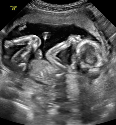 Little Gram 2D Image